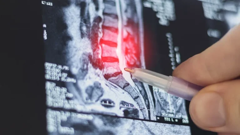 Close-up of a hand pointing with a pen at highlighted red area on a spinal MRI scan.
